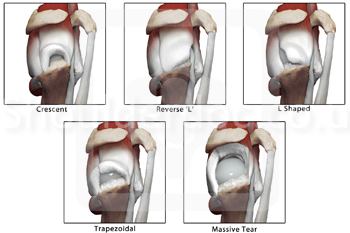 Rotator Cuff Classifications Shoulderdoc